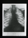 Aneurysma Aorta