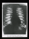 Pneumoperitoneum